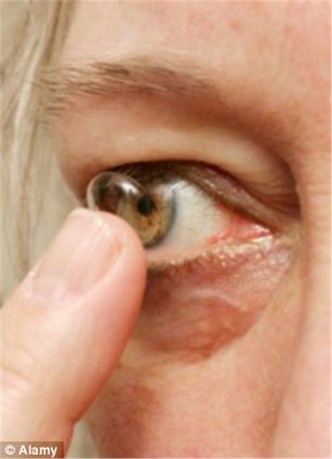 Contact lens which releases drugs into the eye gives new hope to glaucoma sufferers